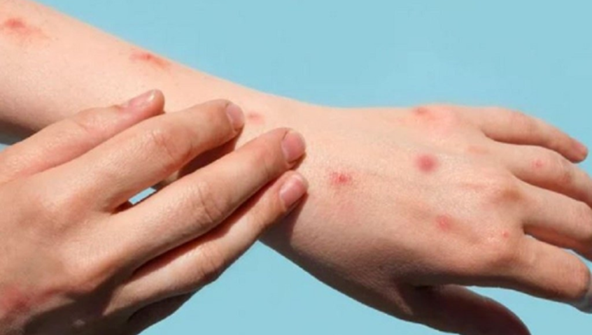 Ghi nhận 2 ca đậu mùa khỉ, Bộ Y tế yêu cầu tăng cường giám sát, điều trị, không để lây nhiễm chéo